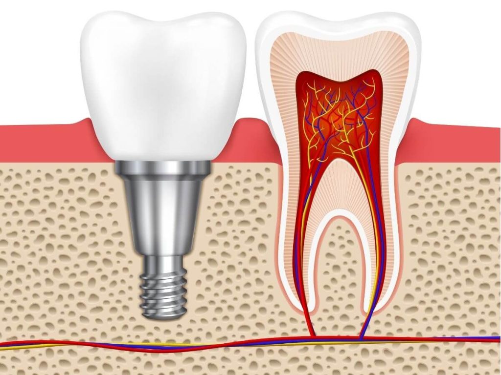 bone grafts or bone graft