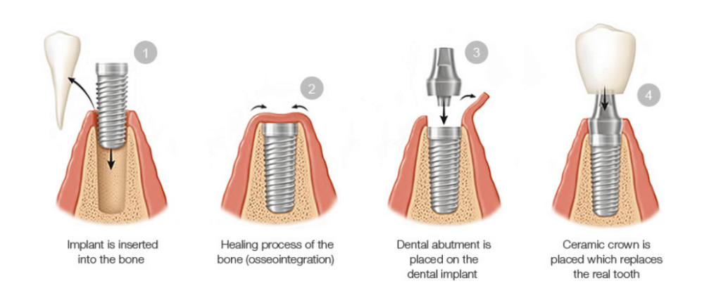 implant dentistry