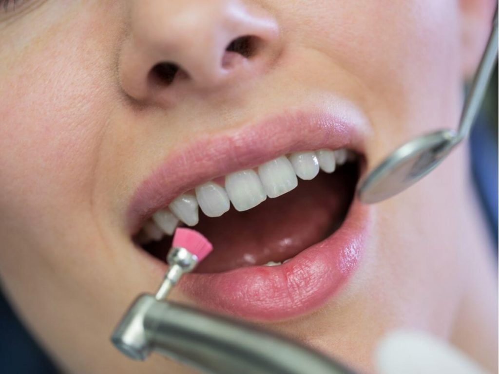 polishing dental scaling around sore gums