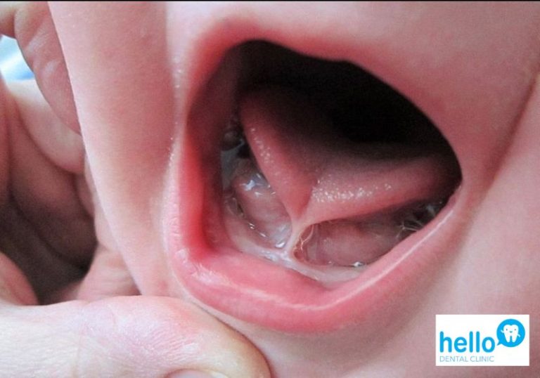 Close-up of a baby with tongue-tie condition, showing restricted tongue movement