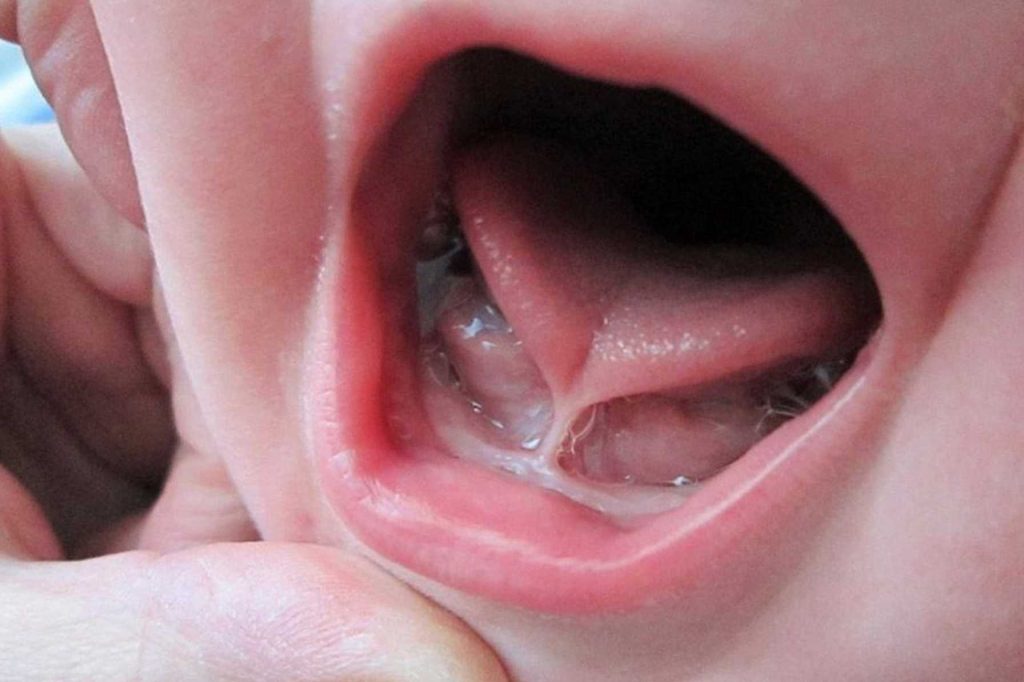 Normal Tongue vs. Tongue Tie: What to Know