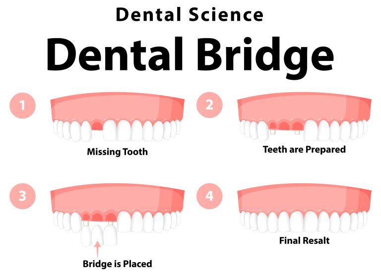 Dental Bridge image