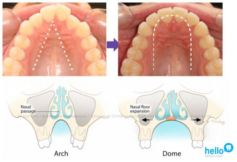 Nasal passages differ between normal and tongue-tied individuals