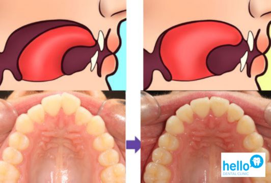 The tongue position inside the mouth differ between normal and tongue-tied individuals