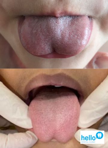 A child , sticking out her tongue with a tongue-tie condition