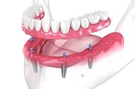 All-on-4 dental implant procedure supporting a full lower denture