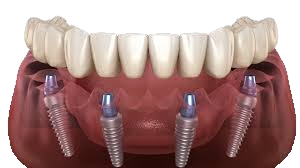 All-on-4 dental implants with full-arch prosthetic placement on the lower jaw