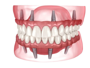 full set of teeth supported by All-on-4 dental implants in the upper and lower jaw